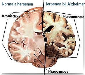 Healthy Brains And Brains With Alzheimer's Disease